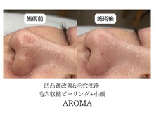 アロマ(AROMA)の雰囲気（開いた毛穴に、毛穴洗浄、毛穴レス、越谷/春日部/草加/大宮）