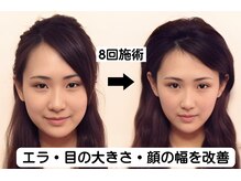 ニュートラル 渋谷店(NEUTRAL)/小顔矯正結果［小顔/骨盤］