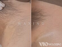 男女人気No.1！ブラジリアンワックスで気になるムレ&臭い解消◎