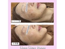 ミニョン(Mignon)/60代女性　シミケア改善写真