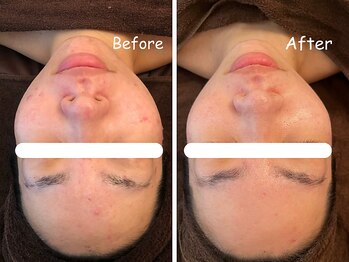 レイ(REI)/◆ニキビケア◆