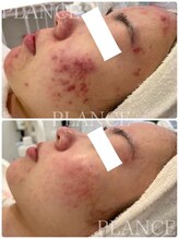 プランス 恵比寿店(PLANCE)/ずっと気になる赤みケア