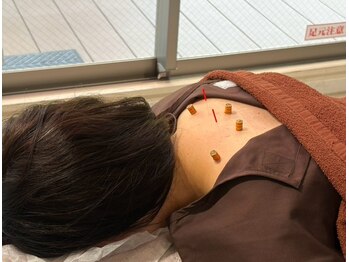 鍼灸院凪日和の写真/長引く首肩コリ・眼精疲労・自律神経の乱れに◆女性鍼灸師による本格施術で根本からスッキリ！