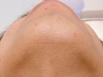 テラス(TERRACE)/メンズひげ脱毛