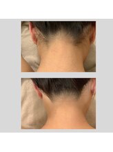 エモベーシック(e'MO BASIC)/襟足脱毛