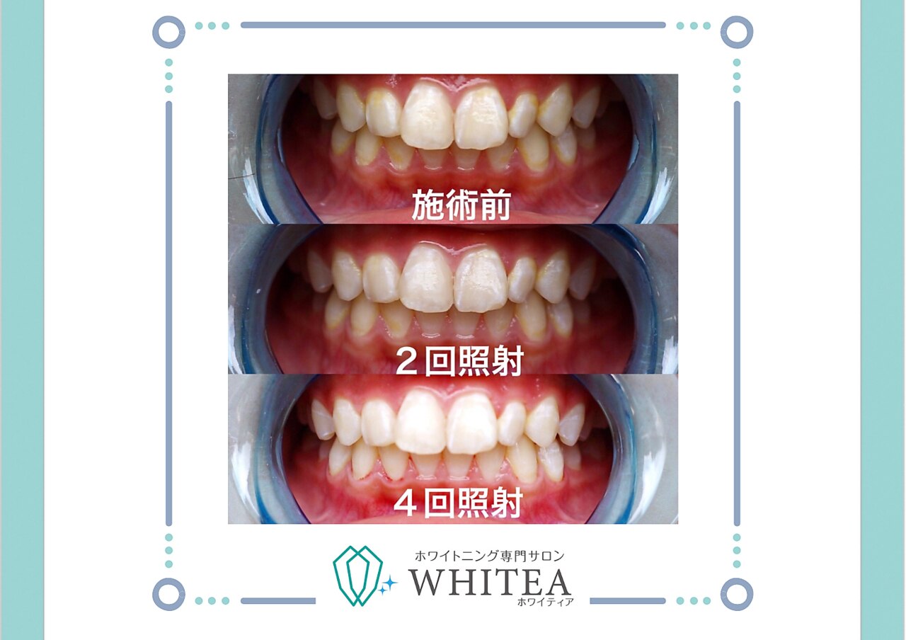 セルフホワイトニング本体 値下げしました！ 付属品あり！サロンの副収入などに セルフホワイトニング本体 値下げしました！ 付属品あり！サロンの副