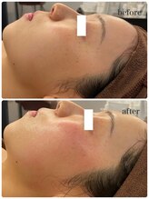 オレアグリーン 岡崎(OLEA green)/ハーブピーリング１回効果