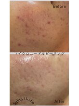 サロン ウルハ(Salon Uruha)/ニキビケアに効果的