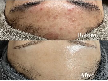 マシェ バイ マユ(Mache by Mayu)/お肌は必ず変わります☆