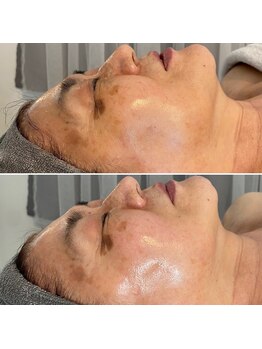 シミしわ改善！予防ケア