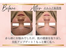 リーズリアン(Rises Lien)/【BeforeAfter】メルニア肌管理