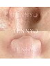 【SNSで話題沸騰中の透明肌ケア】肌育毛穴洗浄☆TENNYO☆¥11,000→¥8,800