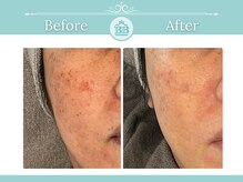 シミケアゼロ美人 表参道店(シミケアZERO美人)/【シミケア/シミゼロ症例】