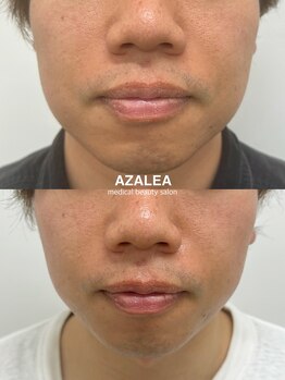 アザレア(Azalea)/マイクロウェーブリフト/恵比寿