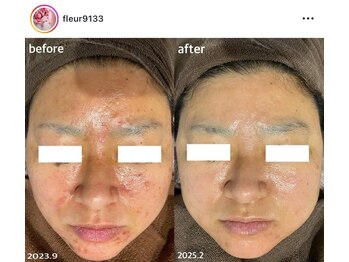 フルール(Fleur)の写真/【毎日キレイをアップグレード】REVIハーブピーリング/毛穴洗浄/プラズマ/ボディケアまで全身美容が可能!