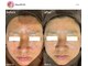 フルール(Fleur)の写真/【毎日キレイをアップグレード】REVIハーブピーリング/毛穴洗浄/プラズマ/ボディケアまで全身美容が可能!