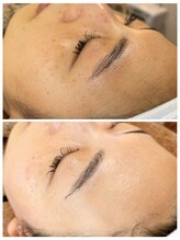 エイチラボ(H lab.)/脱毛【フェイシャルワックス】