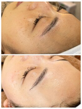 エイチラボ(H lab.)/脱毛【フェイシャルワックス】