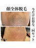 【お得クーポン】顔全体脱毛2回セット　14,000→5,500
