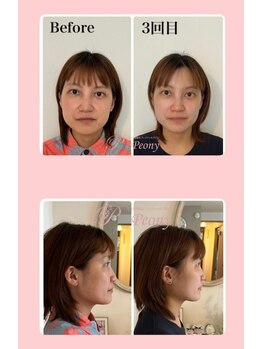 ピオニー(Peony)/Before & After