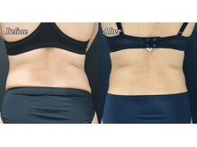 ブリエル(BRILLER)/脂肪冷却（腰）