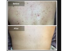 モカ 天王寺店(MOKA)/剥離7回　ニキビケアハーブ毛穴