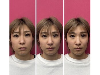 ハチ(HACHI)/