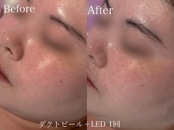 カレンジェビューティー(CarengeBeauty)/ダクトピール+LED1回