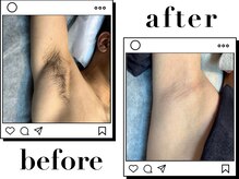 ホワイト(WHITE)/□Before～After〈脇〉