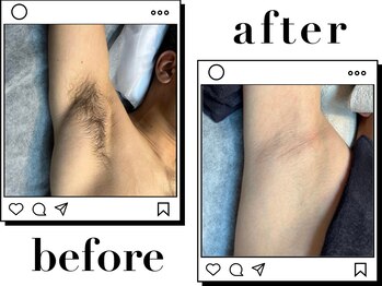 ホワイト(WHITE)/□Before～After〈脇〉