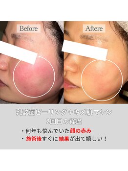 リファラ 光の森店(REFALA)/毛穴・ニキビケア専門REFALA