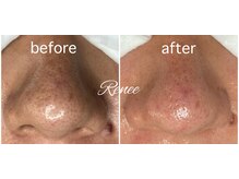 ルネ(Renee)/毛穴エクストラクション