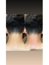 ユウユウ(YUYU)/襟足(Mパーツ)艶の極み脱毛