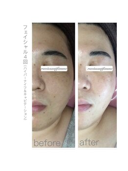 ラヴィソンファム(Ravissant femme)/30代フェイシャル４回