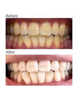 ノーブル(Noble)/ホワイトニングメニュー