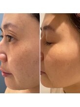 スローティラテ 中道店/イロンハーブピーリング