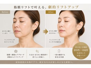 トータルビューティサロン クイーン(Queen)の写真/【小顔フェイシャル】鏡を見るたびに気になるほうれい線・・・筋膜層までアプローチするリフトアップマシン