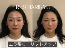 リス(R.i.S)/小顔矯正Before&After