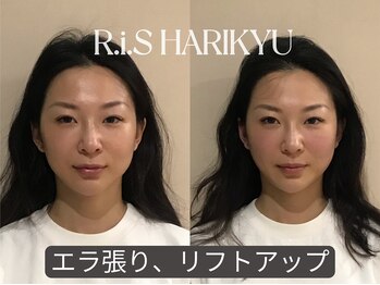 リス(R.i.S)/小顔矯正Before&After