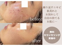 ルアナ(LUANA)の雰囲気（繰り返すニキビケアや凹凸肌ケア・毛穴にも効果を発揮！）