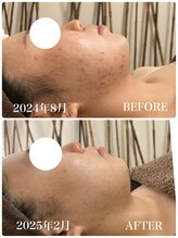 ヴィヴフォー(VIV for)/ニキビケアに。