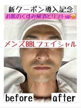 ハニーアイズ(Honey Eyes)/【BBLフェイシャル体験】