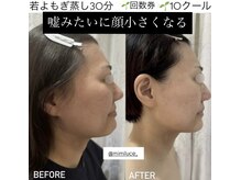 ミミルーチェ(mimiluce)/小顔矯正、30分蒸してこの変化