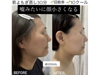 ミミルーチェ(mimiluce)/小顔矯正、30分蒸してこの変化