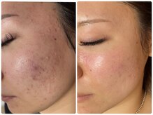 ラヴィ(Ravi)/ニキビケア