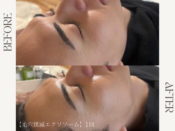 ルカ 北堀江(Luca)/エクソソーム美肌