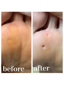 プラスキュア 用賀店(+CURE)/タコうおのめケア60分¥6600~