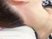 ミチ(MIcHI)/うなじ　WAX脱毛
