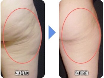 タマエステティックサロン/頑固な下半身もスッキリ☆