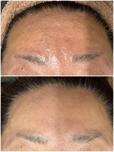 ザ ファーストサロン(The First Salon)/顔筋マッサージでおでこツルツル